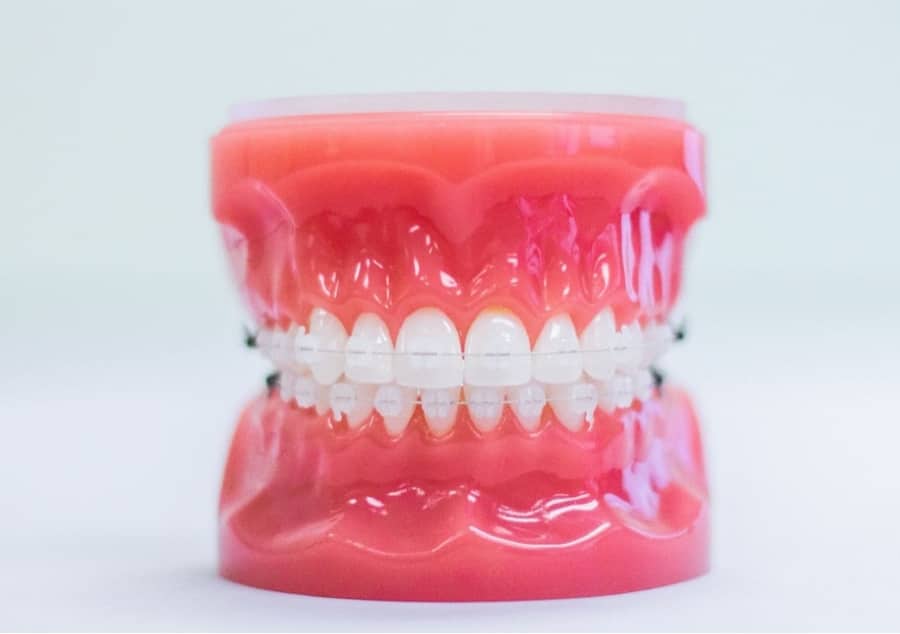 clear braces on plastic model